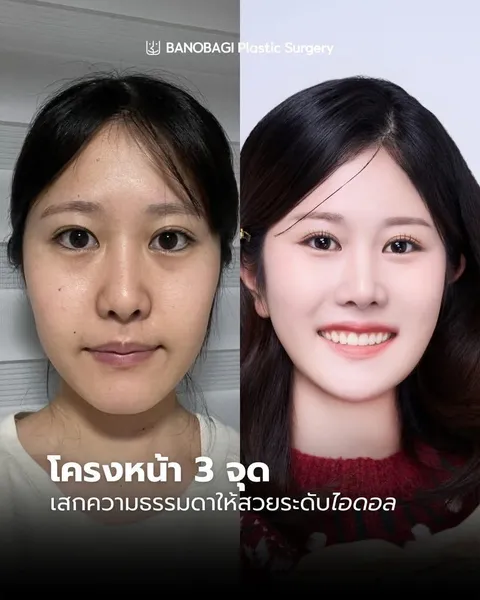 Banobagi Plastic Surgery — โครงหน้า 3 จุด